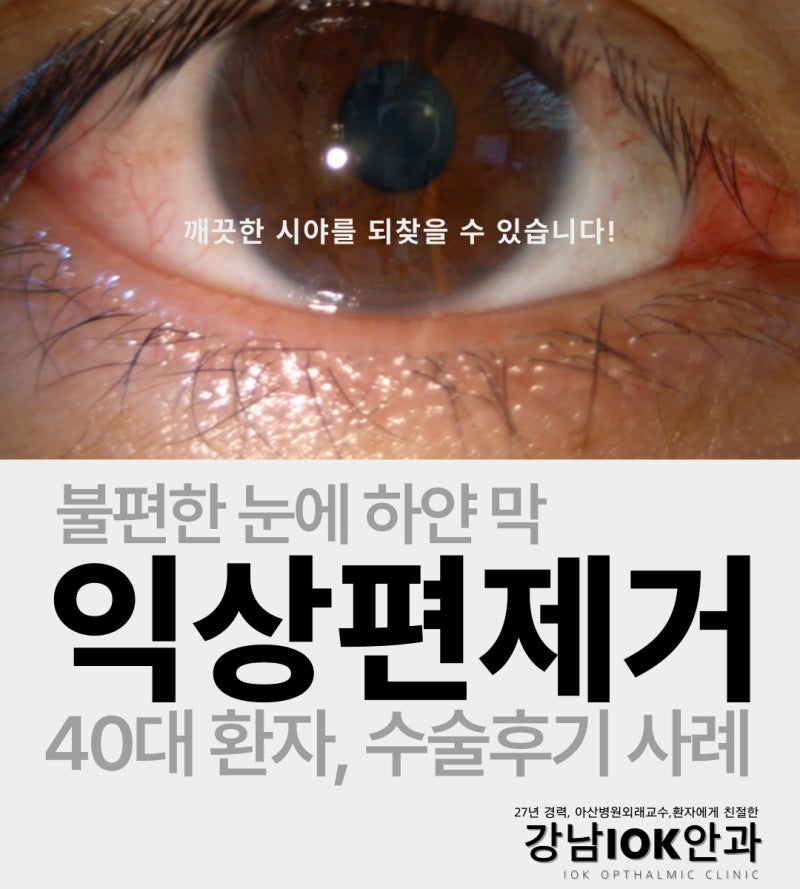 익상편 수술 후기 사례 – 40대 불편한 눈하얀막 제거로 달라진 시야