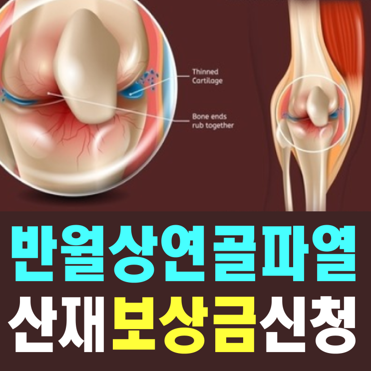  [대구, 부산 노무사] 무릎 반월상연골파열 산재 보상금 신청하려면