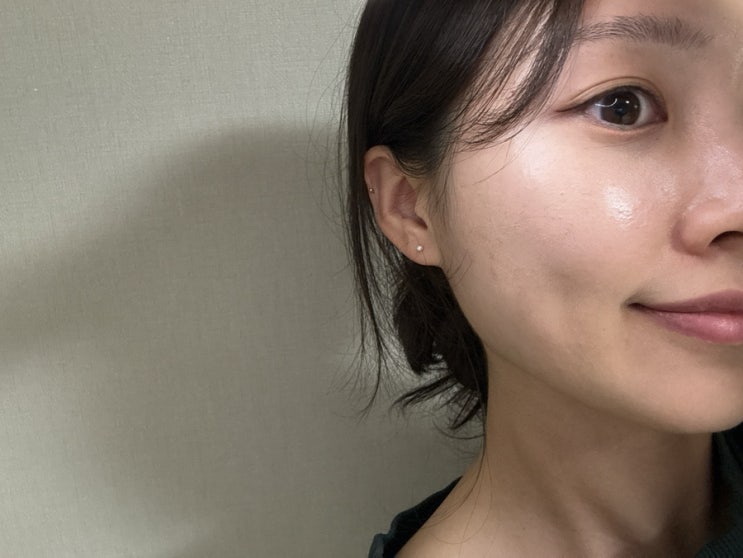  대구 동성로 여드름패인흉터치료 새살침 내돈내산 찐후기