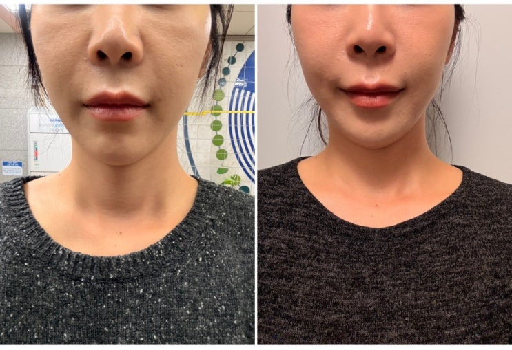  울쎄라프라임 300샷 붓기 팔자주름 심부볼 울쎄라 효과 일주일 차 후기