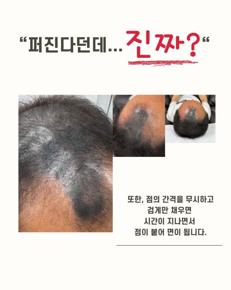  일시적인 커버는 이제 그만, 두피문신으로 편리해진 생활