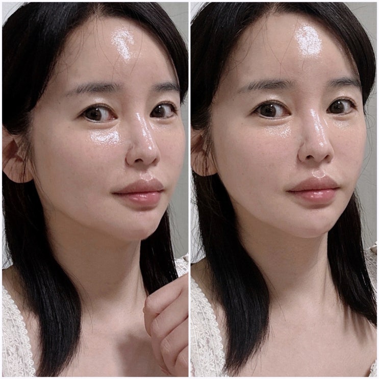 부산 서면 리쥬란 힐러 무통 큐어젯 레이저 진짜 통증 없네! 부산 서면 리쥬란 힐러 무통 큐어젯 레이저 진짜 통증 없네!