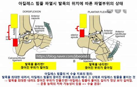  아킬레스건 파열 진단과 증상 및 징후와 수술 후