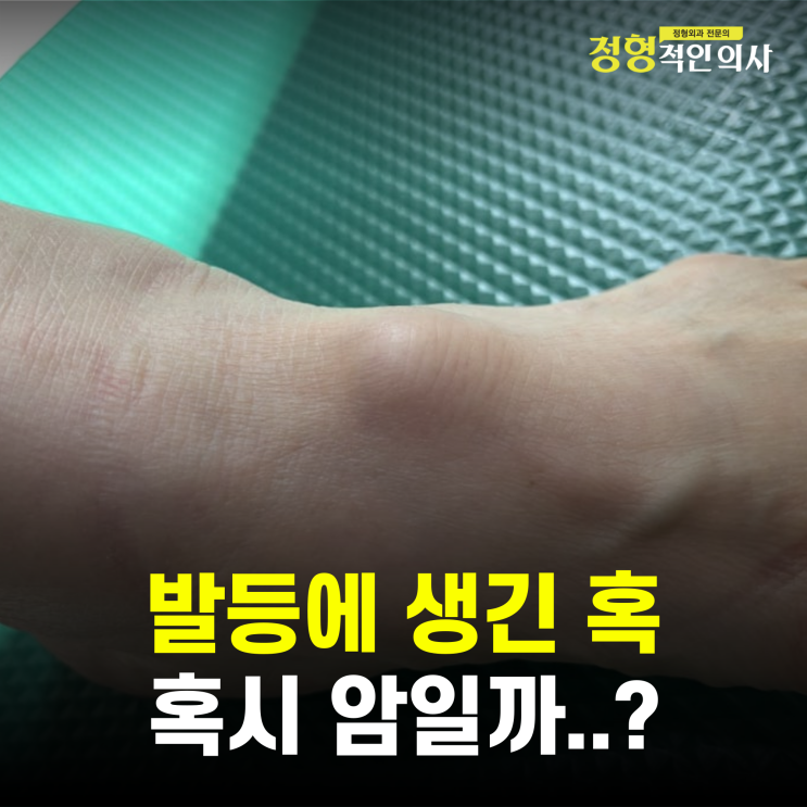  발등 생긴 혹, 혹시나 암일까요? (의사작성)
