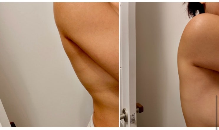  요즘 푹 빠진 등살빼는법 빠르게 뒤태다이어트 성공한 이오팻 후기