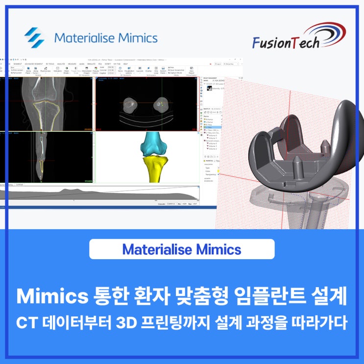  [Materialise S/W] Mimics 통한 환자 맞춤형 임플란트 설계, CT 데이터부터 3D 프린팅까지 설계 과정을 따라가다