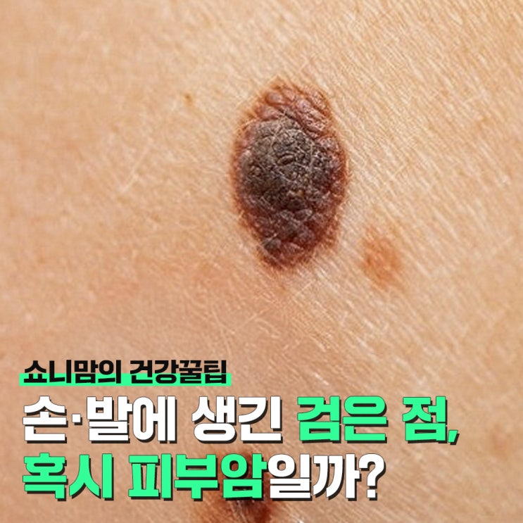 손, 발에 생긴 점점 커지는 검은 점, 혹시 피부암일까?
