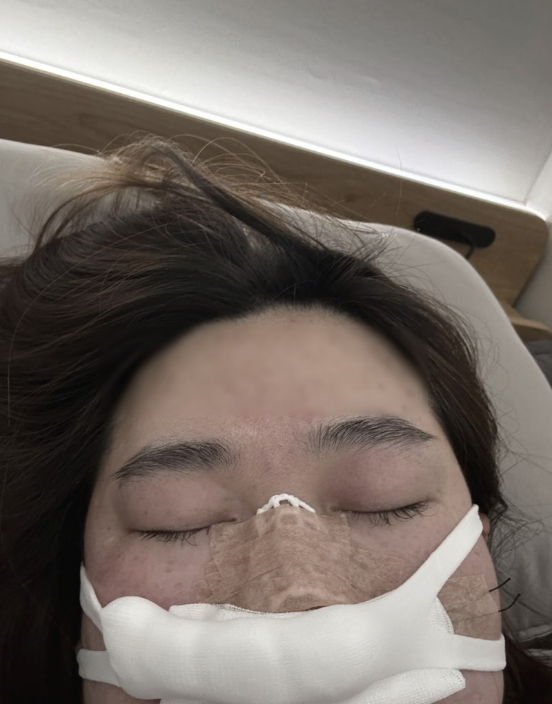 부산 코앤핑 이비인후과 코뼈골절 비관혈적 정복술 당일 입원 수술 비용 및 통증후기