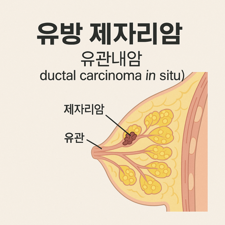  유방제자리암의 정의, 치료방법 및 부작용