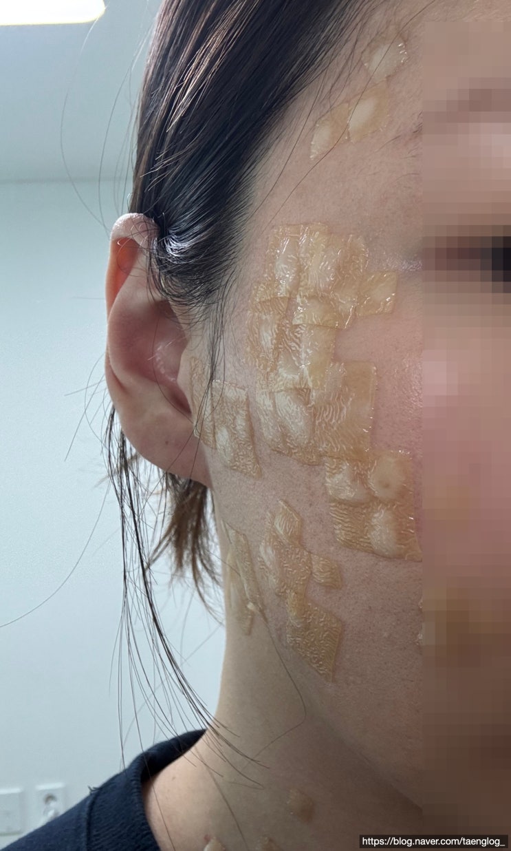  편평사마귀 레이저 제거 후 듀오덤 교체 주기, 가려움 후기 - 3일차, 7일차 사진