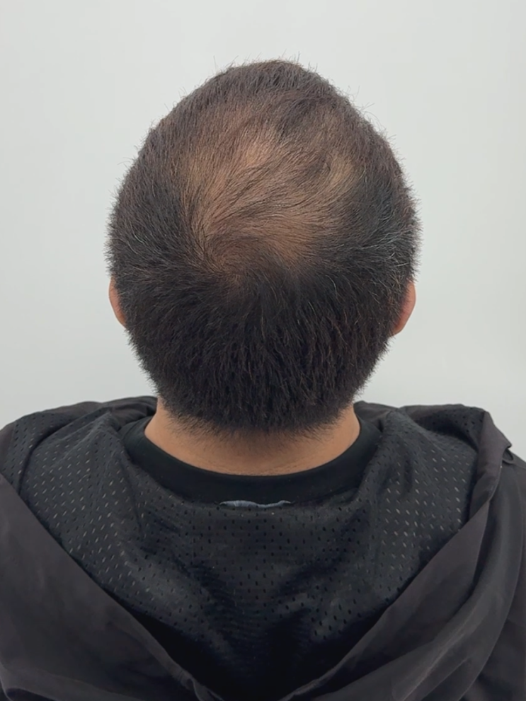  정수리 탈모, 나이 탓일까요? 두피문신으로 커버하세요.