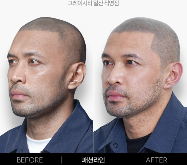 일산두피문신 모자로부터 탈출 성공