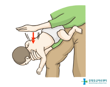  아기 하임리히법, 귀여운 생명을 살리는 응급처치의 비밀