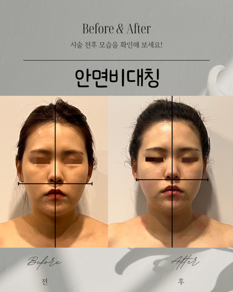  안면비대칭  휜코 삐둘빼뚤