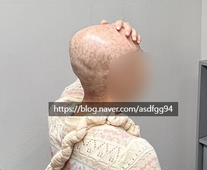  인청 두피관리케어 웰킨 청라점 암환자 두피관리 강추