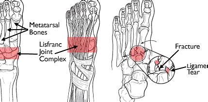 골절-족부 탈구(Lisfranc 부상)
