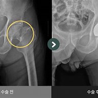 고관절 골절 ( 대퇴골 경부 골절; 대퇴골두 골절; Subcapital Fractures; intertrochanteric 골절; Subtrochanteric Fractures)