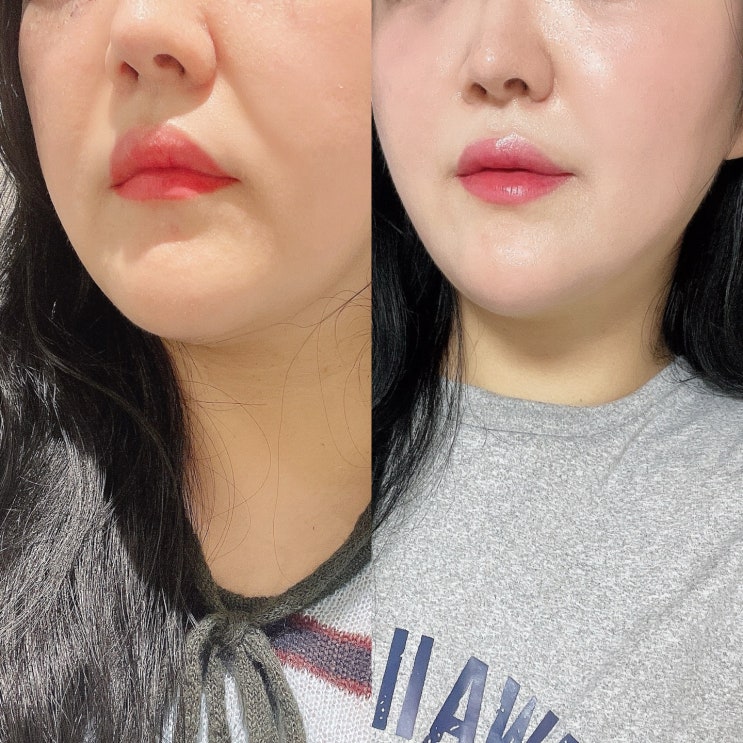 부전동 피부과 써니리프팅 팔자주름 턱선 3주차 후기