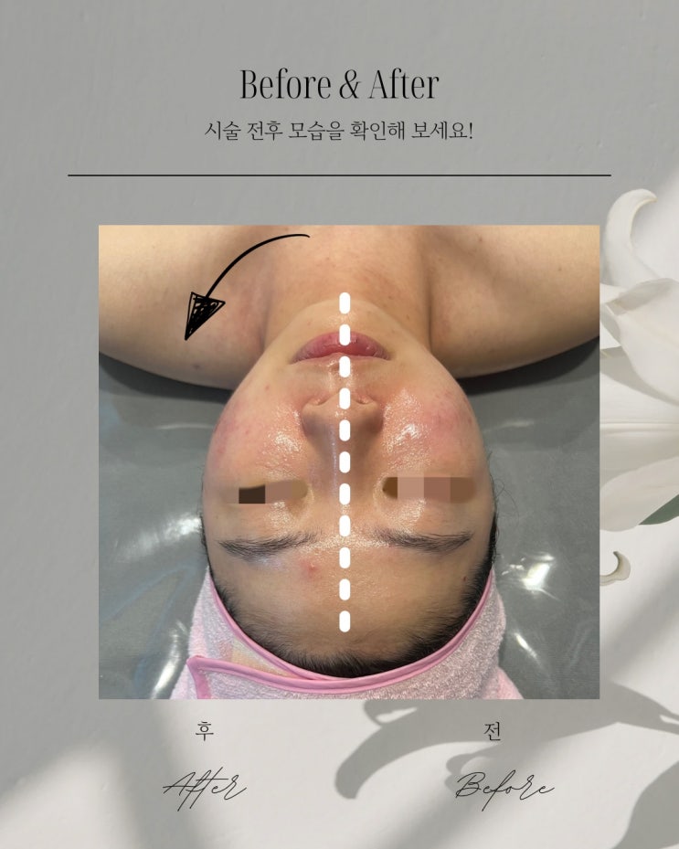  부산피부관리 윤곽관리 얼굴 반쪽만 관리했는데, 이렇게 달라져요?