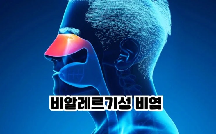  비염 종류 비염 치료 비염에 좋은 19가지 음식