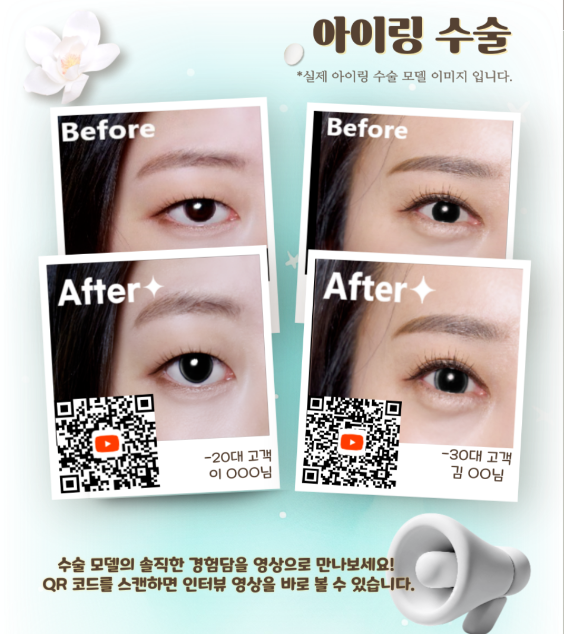 아이링 수술 가능한 병원 목록, 시술이 불가능한 사례 정리