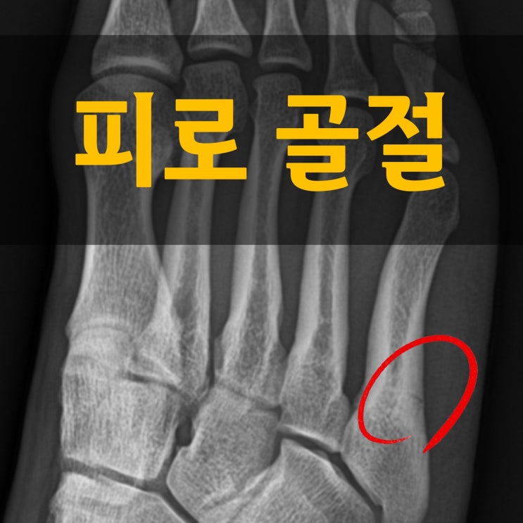  운동선수 피로골절 증상 치료 충격 누적 부위
