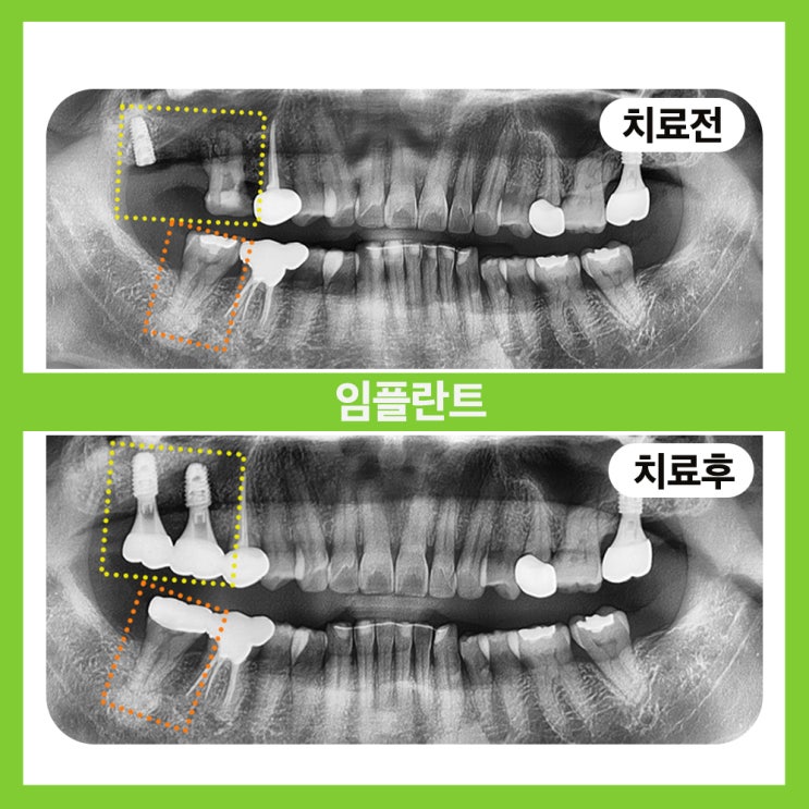  송파구치과 보철이 불가능한 위치에서 임플란트 재수술로 해결을!