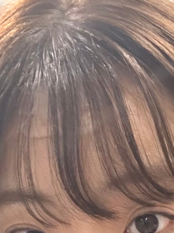 이마 고데기 데임 화상 자국 없애는 연고 대신 습윤밴드