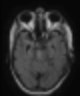 뇌경색(brain infarction) 발생부위별(MCA, ACA, PCA 등) 증상, CT&MRI 기본판독 : 네이버 블로그