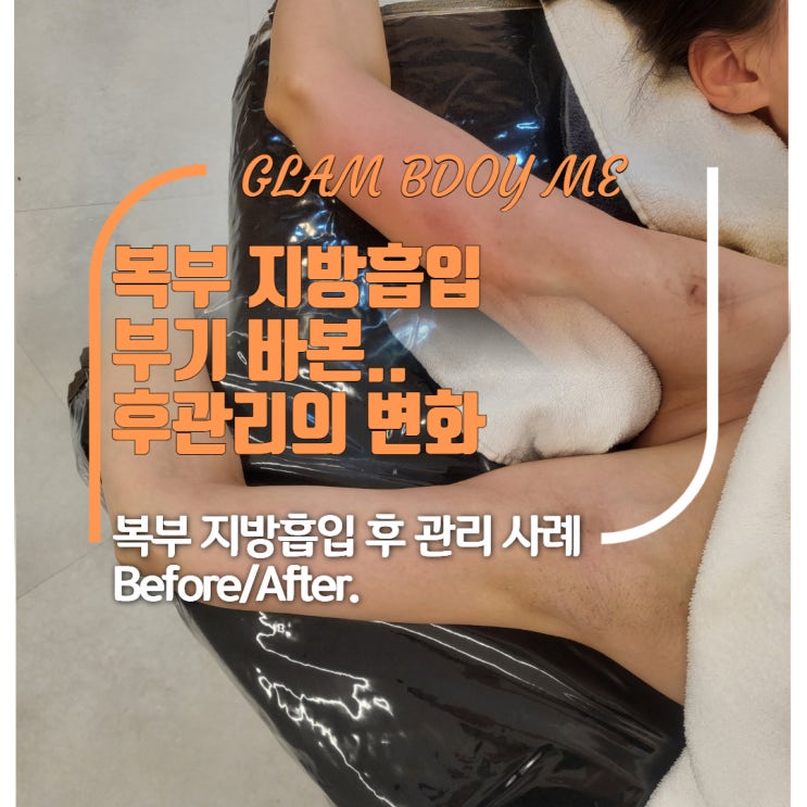  팔 지방흡입 후 나타난 유착관리 (2주 차 - 5주 차) B&A