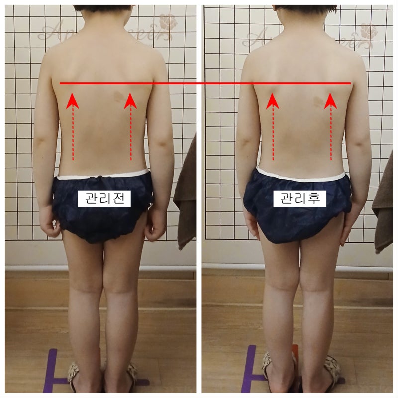울산 성장 클리닉 성장판 검사 대신 키성장 테라피 추천