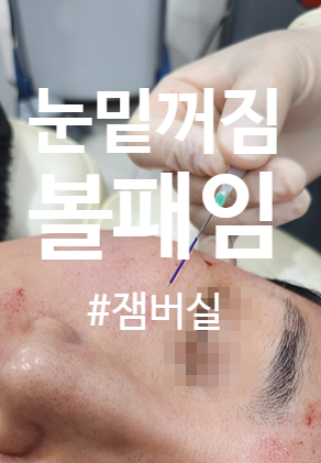  눈밑꺼짐 볼패임 잼버실 리프팅 유지기간 아르네의원