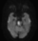 뇌경색(brain infarction) 발생부위별(MCA, ACA, PCA 등) 증상, CT&MRI 기본판독 : 네이버 블로그