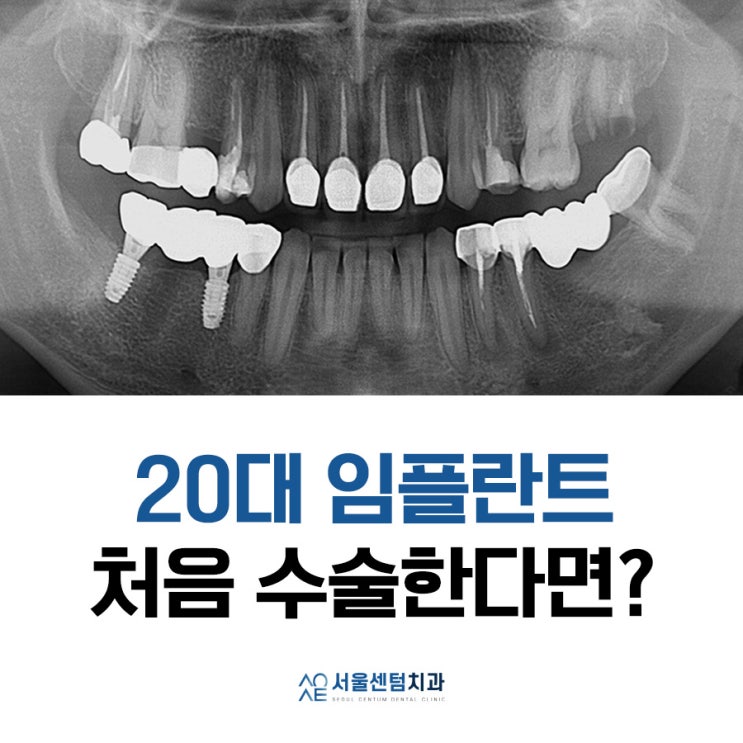  20대임플란트 처음이라 두렵다면