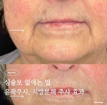  심술보 없애는 법 윤곽주사, 지방분해주사 효과는?