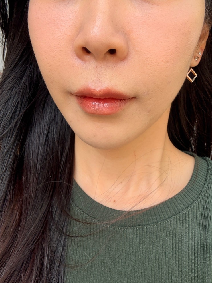  울쎄라피프라임 300샷 팔자주름 심부볼 한달 차 비교 후기