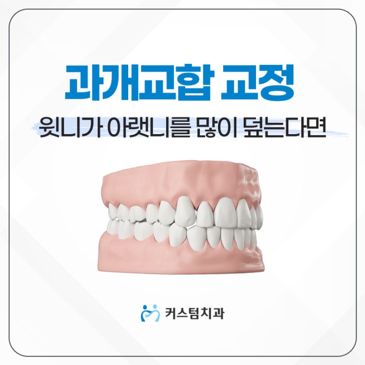  신중동역치과 윗니가 아랫니를 덮는다면