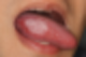 혀에 생긴 하얀 반점, 구강 편평상피세포암일 확률은?