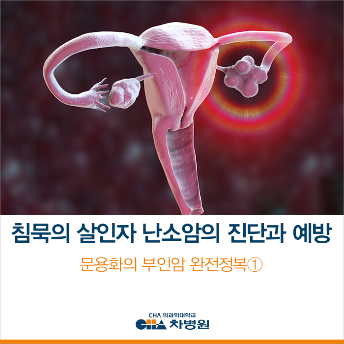 침묵의 살인자, 난소암의 진단과 예방 (문용화의 부인암 완전정복①)