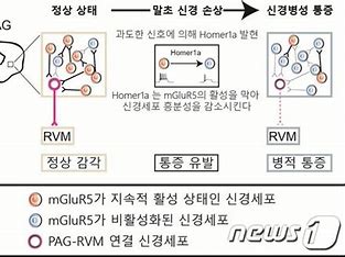 신경병성 통증의 증상진단 및 징후와 치료