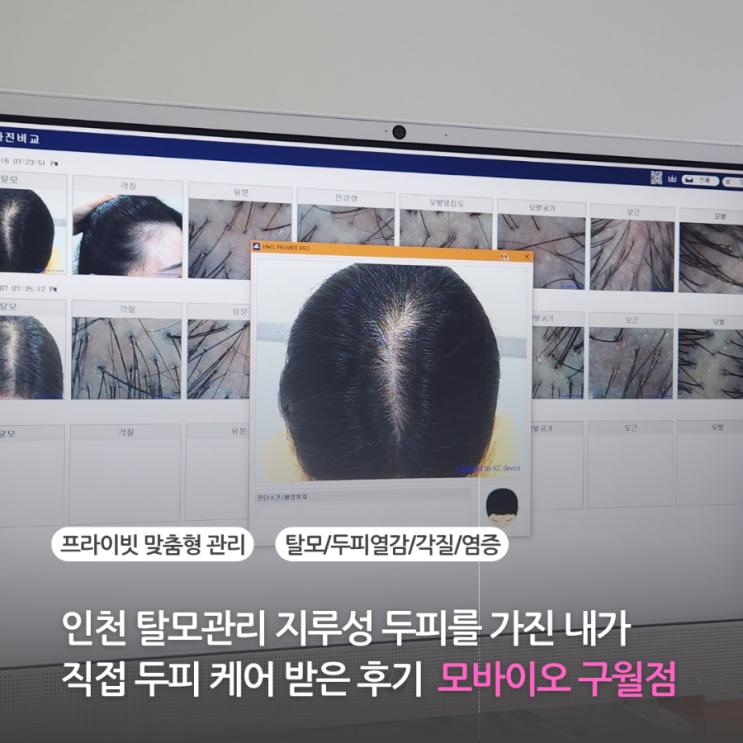 인천 탈모 구월동 두피관리 모바이오에서 지루성 두피 케어받은 솔직 후기 열감 각질 염증 완화