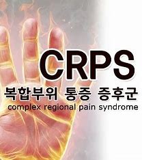 복합 부위 통증 증후군(CRPS)(반사 교감신경 이영양증 및 인과 관계)