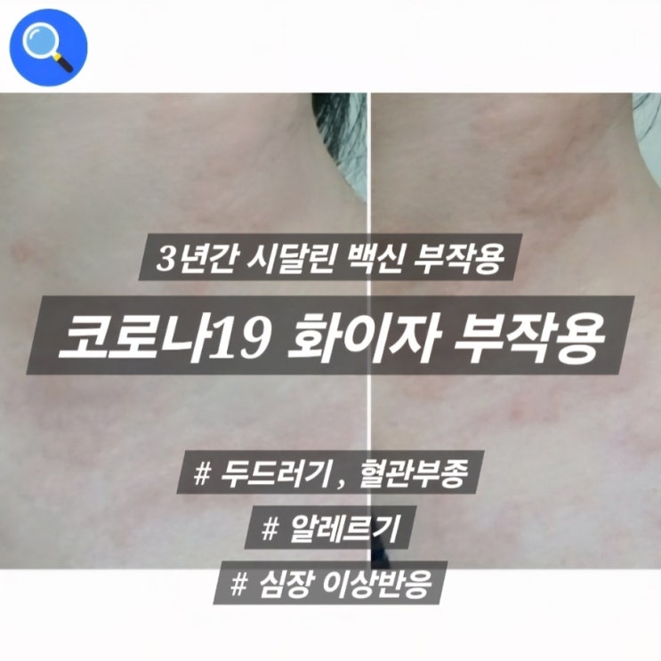  화이자백신 부작용 후기 3년간 두드러기 부종 심장이상