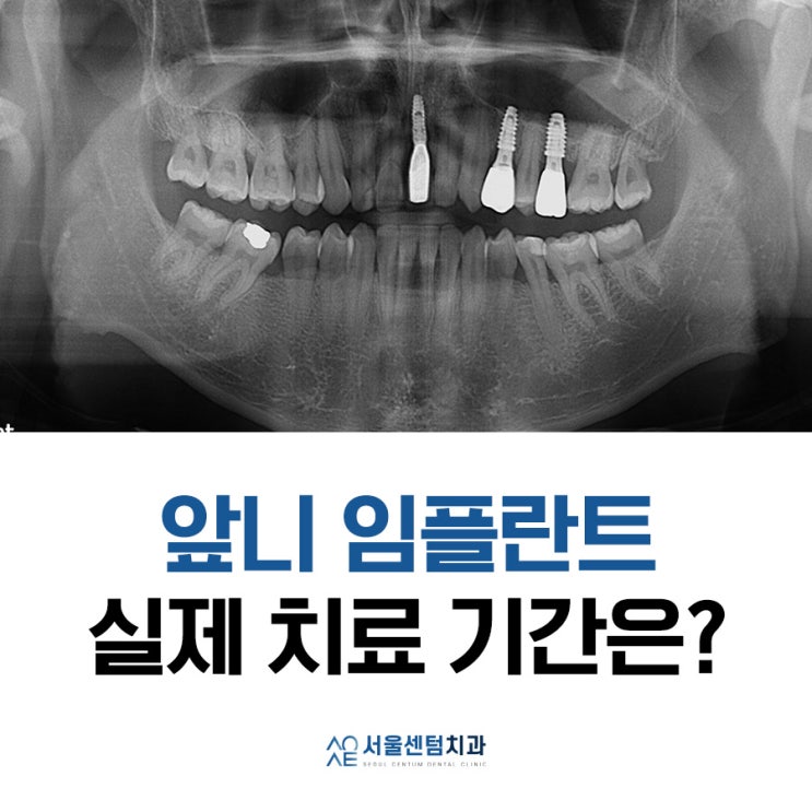  앞니 임플란트기간 실제 수술사례로 알려드려요