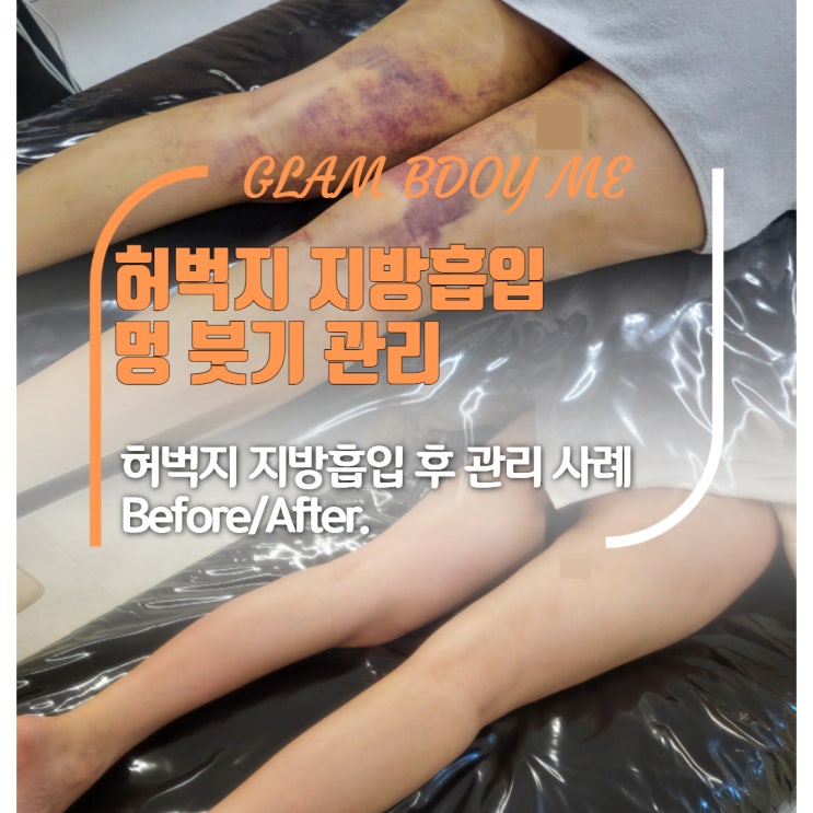  허벅지 지방흡입 후 멍과 붓기 언제 사라질까? 실제 관리 사례로 알아보기