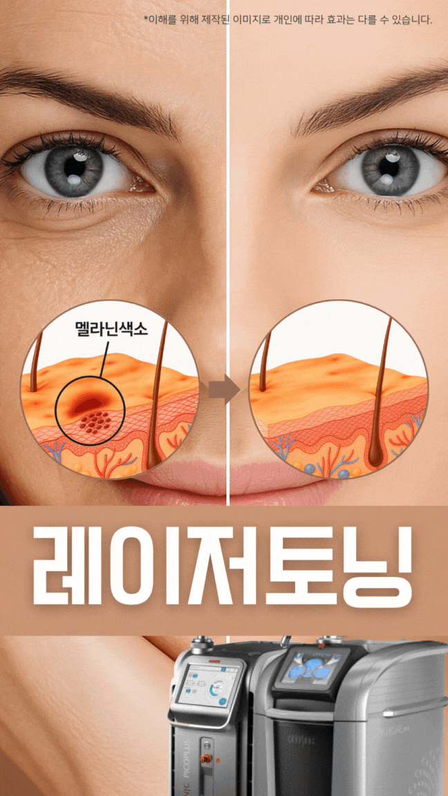  광주레이저토닝 주근깨 고민 피코토닝으로 지울 수 있을까