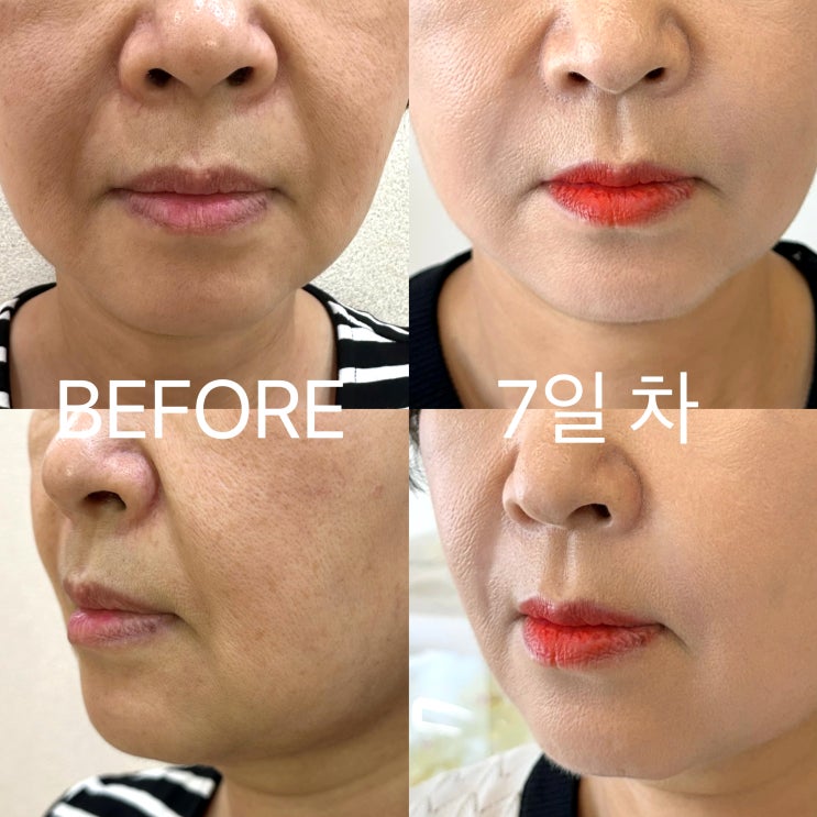  강남역 성형외과 50대 엄마 쥬브젠 자가진피재생술 팔자주름 후기(가격 흉터 지속기간 등)