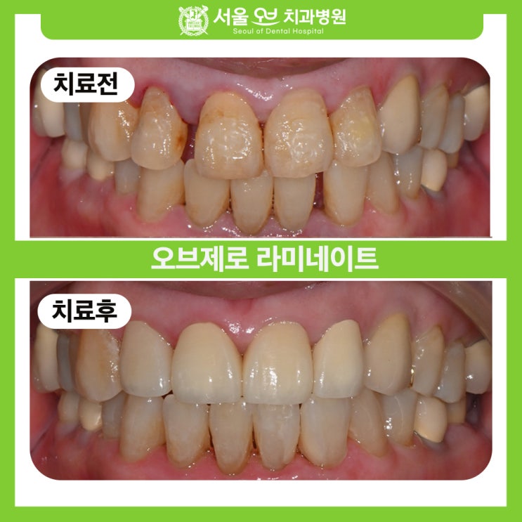  송파구치과추천, 외상으로 인해 오브제로 라미네이트를!