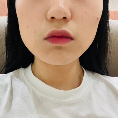 이중턱·사각턱 피팅리프팅 1회차 후기-다이어트 병원에서 느낀 전후 변화와 솔직 체감