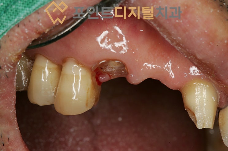  [탕정치과]  파절치아, 이를 빼고 싶지 않아요(캐스팅 포스트 치료) / 천안 아산 불당 배방